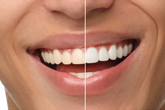 Reserva tu cita y te asesoraremos sobre los tratamientos de blanqueamiento dental
