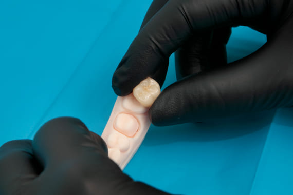 Reserva tu cita y te asesoraremos sobre la colocación de coronas dentales