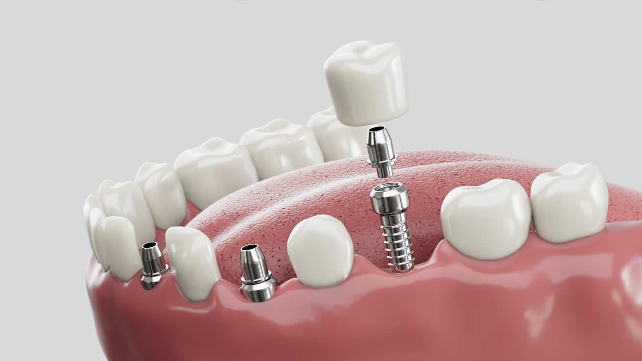 En Bravo & Lizaso somos expertos en implantología dental